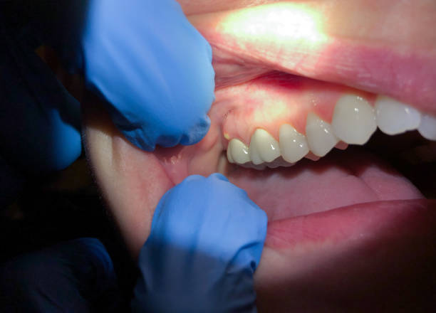 Best Emergency Dental Care for Broken or Chipped Teeth in Tuolumne City, CA